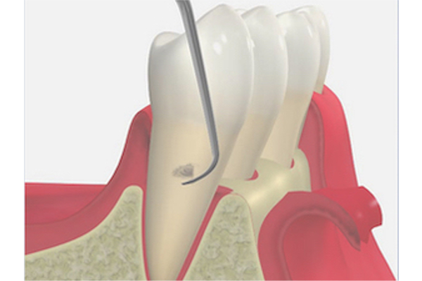 歯周外科処置(フラップ手術)でプラークや歯石を除去しているイラスト