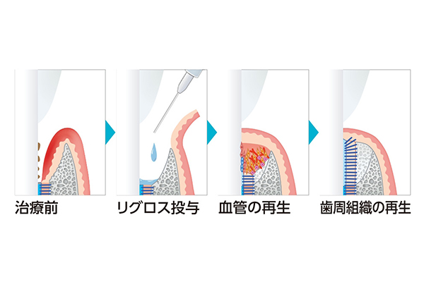 フラップ手術時の歯周組織再生材「リグロス」の使用方法