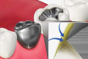 歯と詰め物の隙間に汚れが溜まっているイラスト