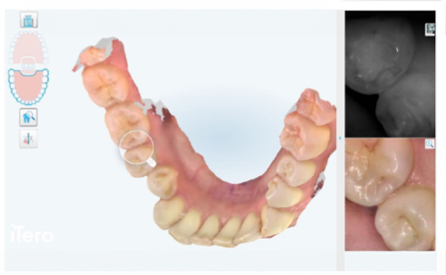 口腔内スキャン・虫歯チェック