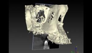 麻布十番歯科のサージカルガイド制作の3D設計のCT画像