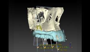 麻布十番歯科のサージカルガイド制作での模型のスキャンデータとCTの合成イメージ