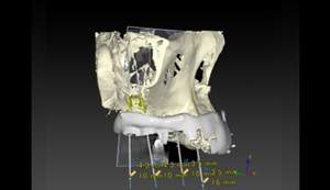 麻布十番歯科のサージカルガイドは3Dプリンターにて制作