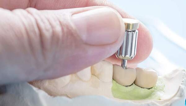 麻布十番の歯医者さんのインプラント治療の仮歯のイメージ