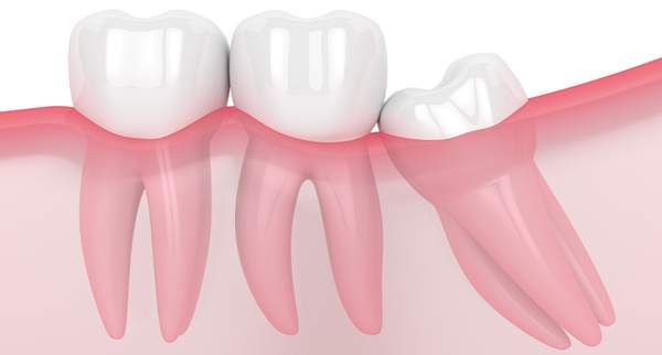 親知らず・抜歯
