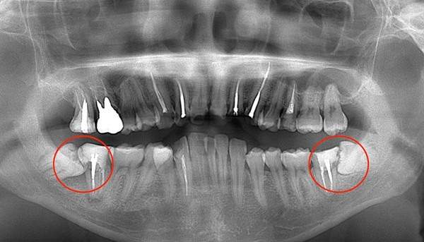 麻布十番歯科で下顎の親知らずが斜めに生えている症例のレントゲン写真