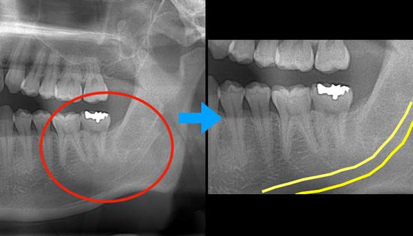 麻布十番歯科の奥歯と下歯槽神経の位置を把握するためのCT画像