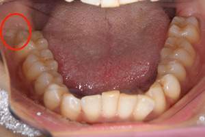 麻布十番歯科で抜歯予定の親知らずの位置を示した口腔内写真