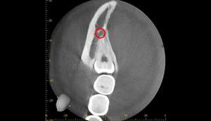 麻布十番歯科での右下の親知らずが真横に生えている症例のCT画像①