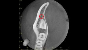 麻布十番歯科での1回目の親知らず抜歯から3ヶ月後のCT画像①