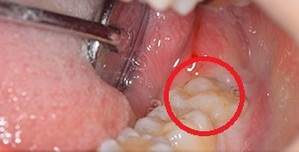 歯茎に埋まっている親知らず