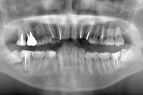 麻布順番歯科の斜めに生えている親知らずが虫歯になっている症例のレントゲン写真