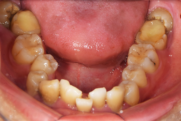 麻布順番歯科の斜めに生えている親知らずが虫歯になっている症例の口腔内の写真