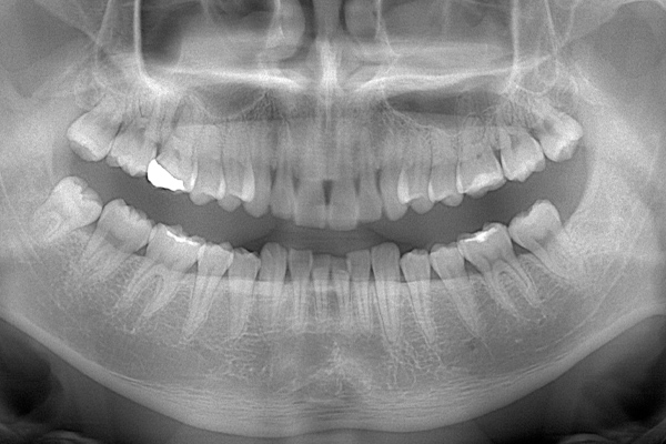 麻布十番歯科の上下顎萌出の親知らず症例のレントゲン写真