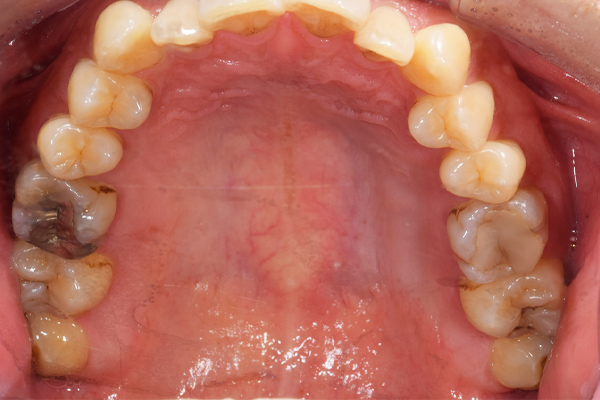 麻布十番歯科の上下顎萌出の親知らず症例の口腔内写真