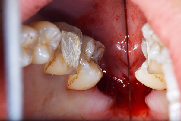 麻布十番歯科で上顎の斜めに生えている親知らずの抜歯後の口腔内写真