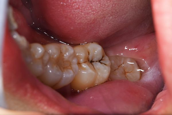 麻布十番歯科で下顎の斜めに生えている親知らずの抜歯前の口腔内写真