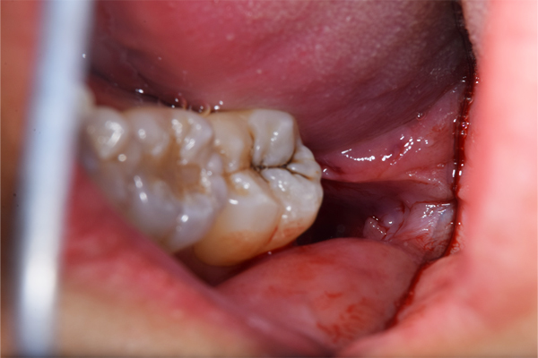麻布十番歯科で下顎の斜めに生えている親知らずの抜歯後の口腔内写真