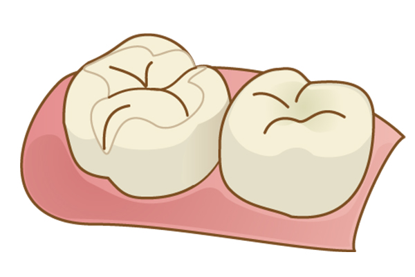 ハイブリッドセラミックインレー