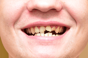 歯が折れた男性