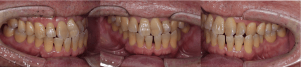 麻布十番の歯医者さんで定期検診を受けた後の症例写真