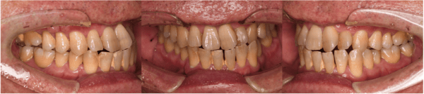 麻布十番の歯医者さんで定期検診を受ける前の症例写真