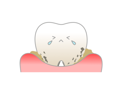 歯周病の進行により歯ぐきが炎症し腫れているイラスト