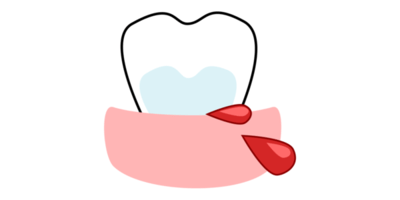 歯ぐきから出血しているイラスト