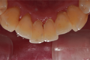 歯石除去（SC）