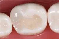 麻布十番の歯医者さんでセラミックインレーを詰めた状態のイメージ