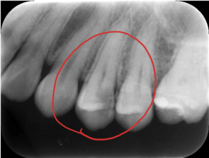 虫歯症例のレントゲン写真。虫歯は黒く写ります。