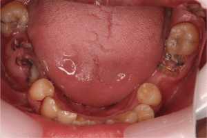 C4状態の虫歯症例の口腔内写真