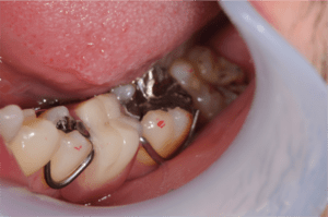 C4の歯を抜歯後入れ歯をセットした症例の口腔内写真