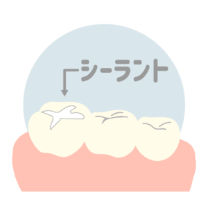 シーラント材を詰めた歯のイラスト
