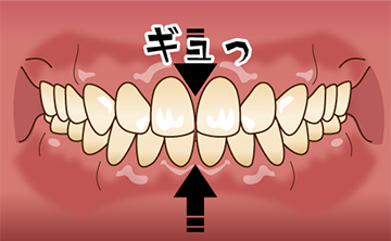 クレンチング(食いしばり)