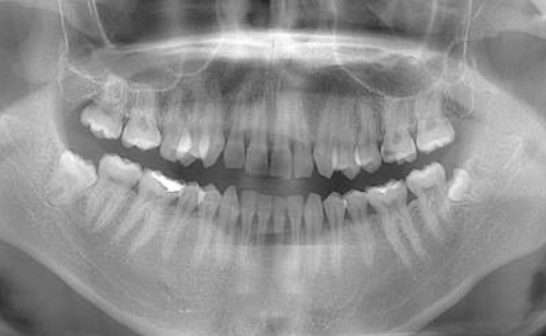 麻布十番の歯医者さんで歯石除去を行っているイメージ
