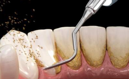 麻布十番の歯医者さんでフッ素塗布を行っているイメージ